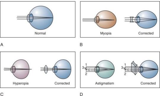 szenilis myopia és hyperopia