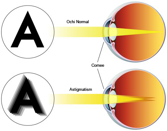 Cum se tratează hipermetropia cu astigmatism